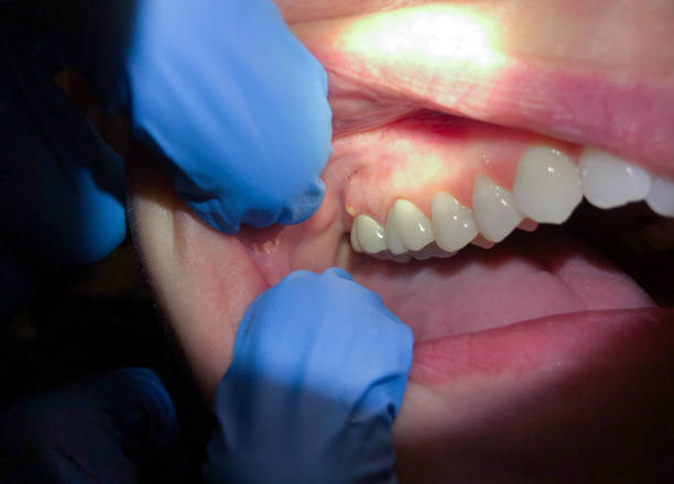Best Emergency Treatment for Toothache in Abbeville, LA